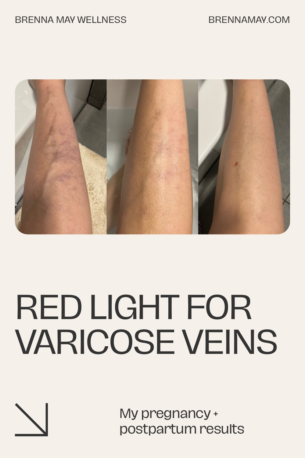How I Calmed Painful Pregnancy Varicose Veins (and Faded Spider Veins) With Red Light Therapy